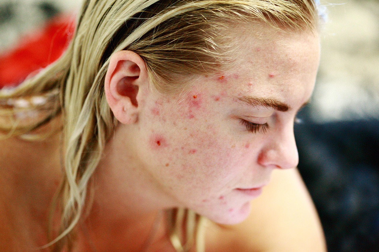 Utah Turns Acne Treatment Into an AI Regulatory Sandbox